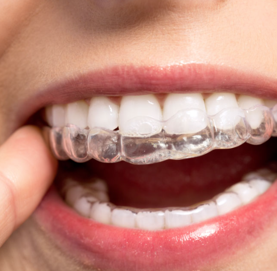 Invisalign Birmingham Central Orthodontics