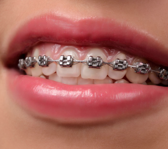 Metal Braces Birmingham Central Orthodontics