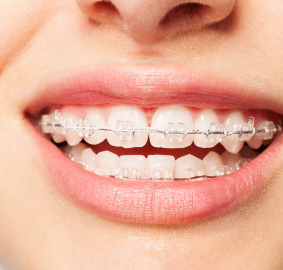 Ceramic Braces Birmingham Central Orthodontics
