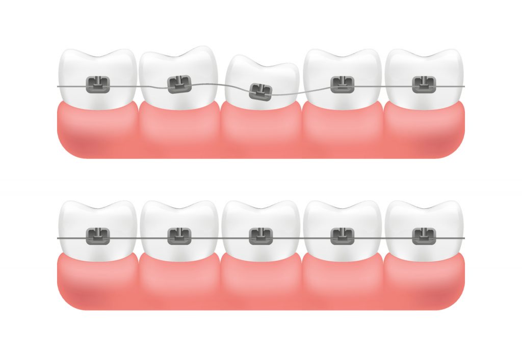 How to Brush Your Teeth With Braces? Central Orthodontics