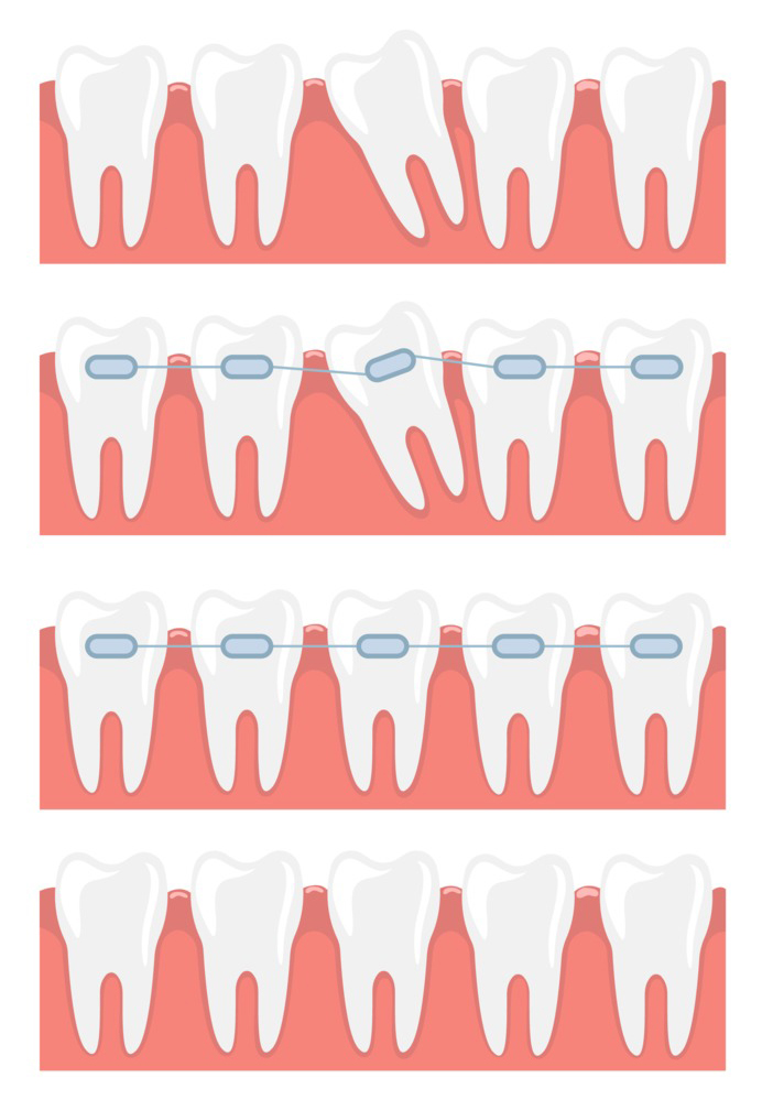 Requirements for Braces Do I Need a Brace? Central Orthodontics